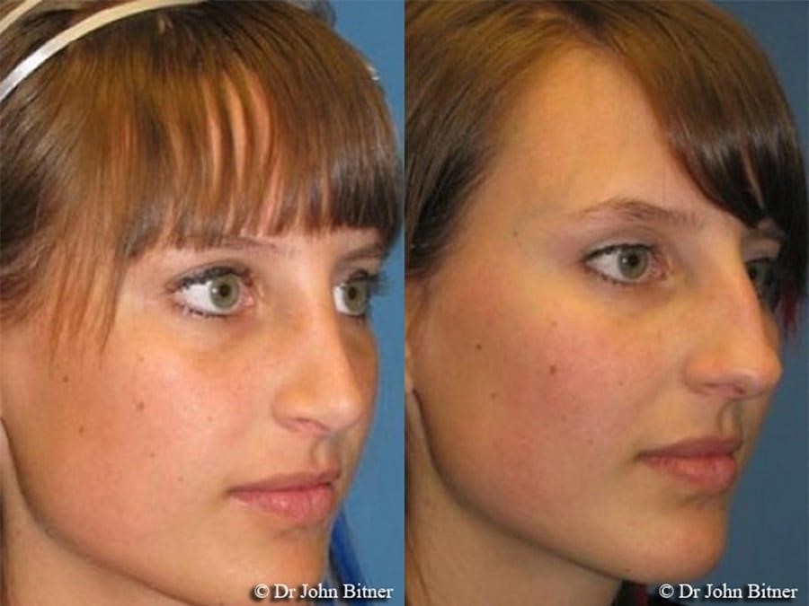 revision rhinoplasty experts