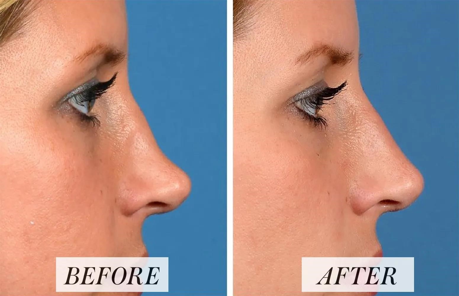 revision rhinoplasty experts