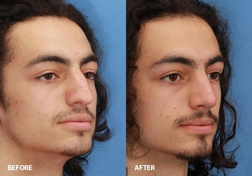 revision rhinoplasty experts